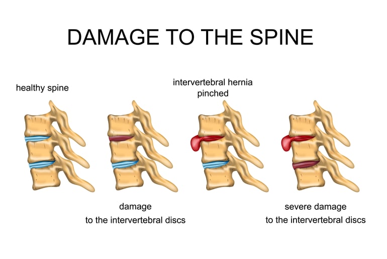 Intervertebral Disc Herniation